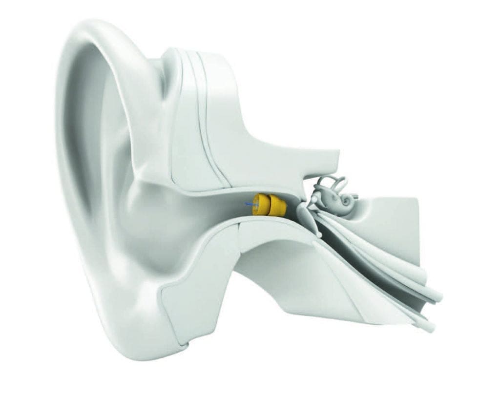An illustration of the lyric hearing device resting in the ear canal